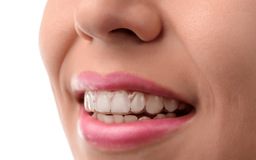 Invisaling – Dentaclinic Studi Dentistici