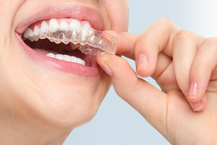 Invisalign