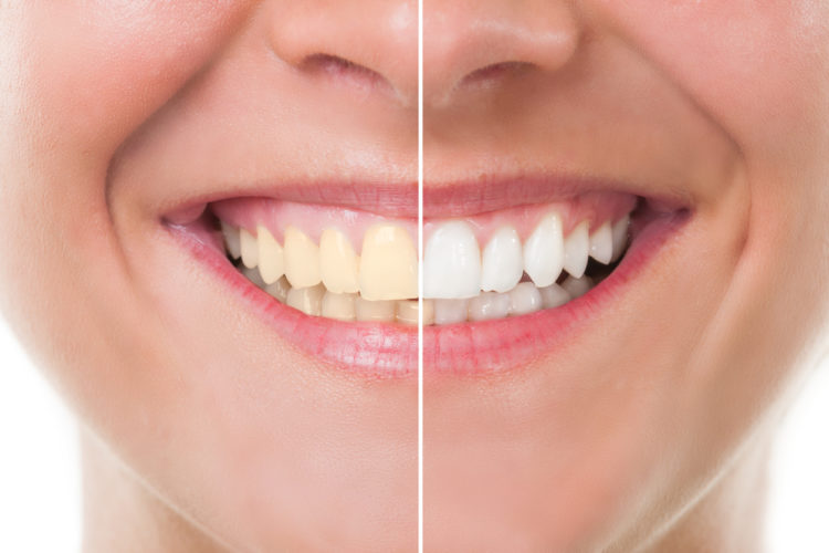 Sbiancamento dentale professionale