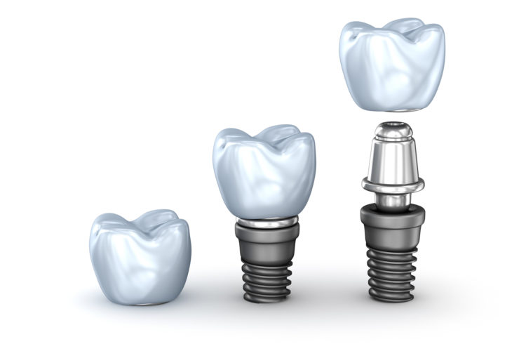 Impianti dentali cosa sono