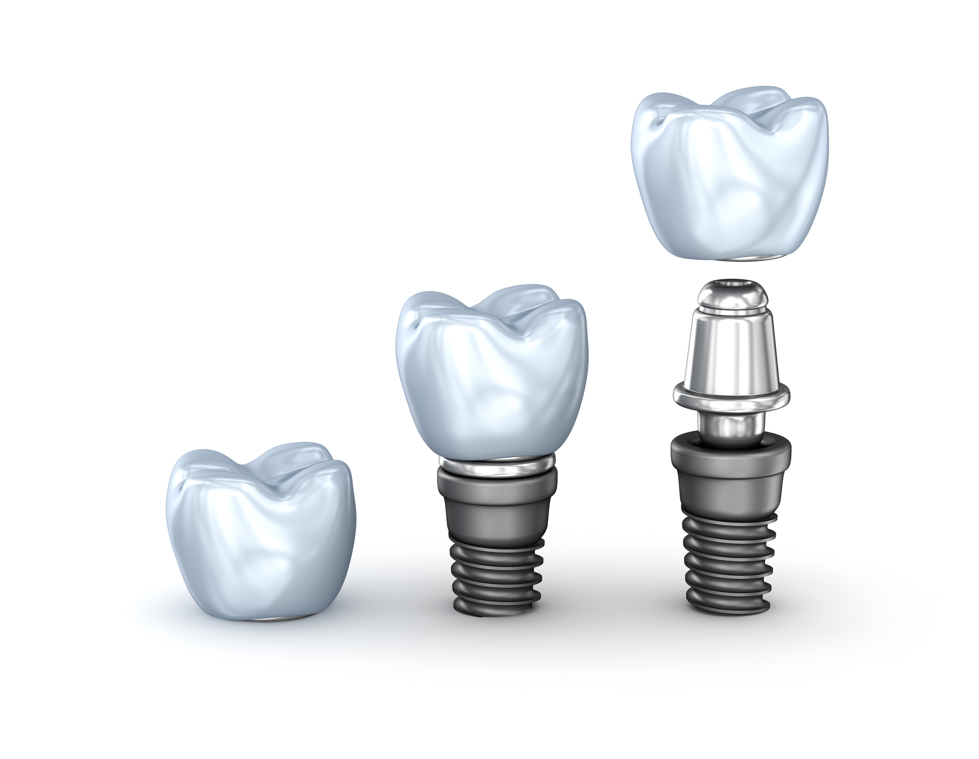Impianti dentali cosa sono