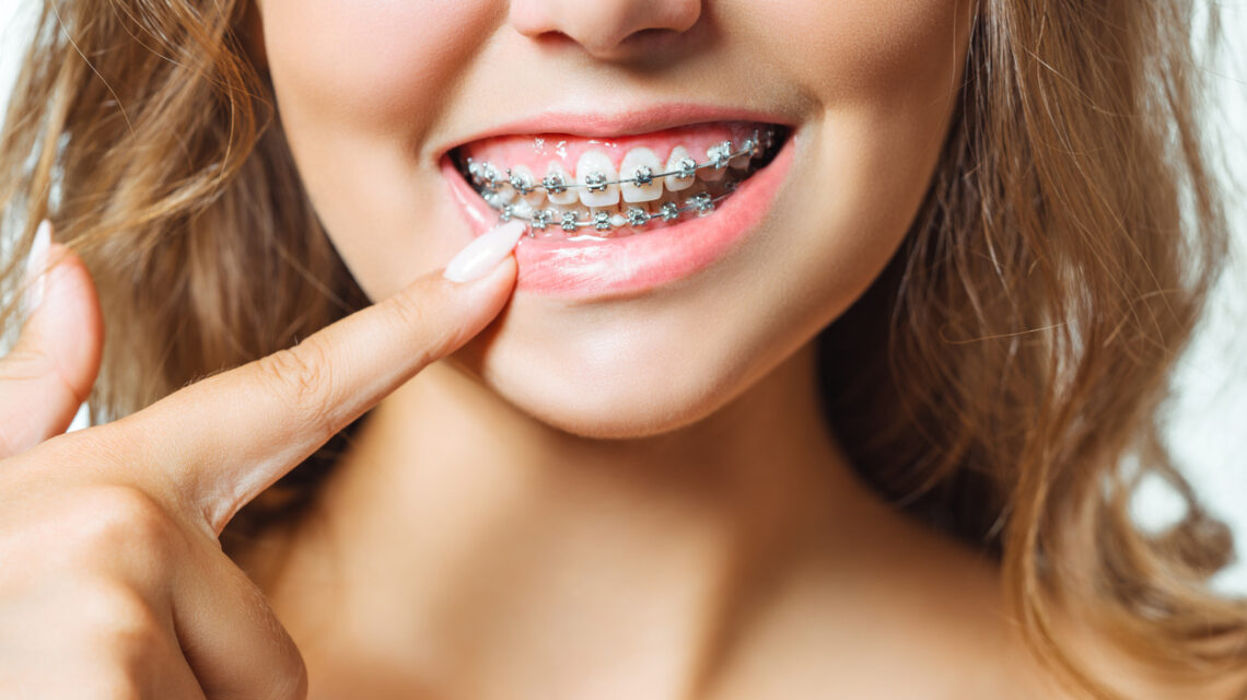 Apparecchi denti fissi