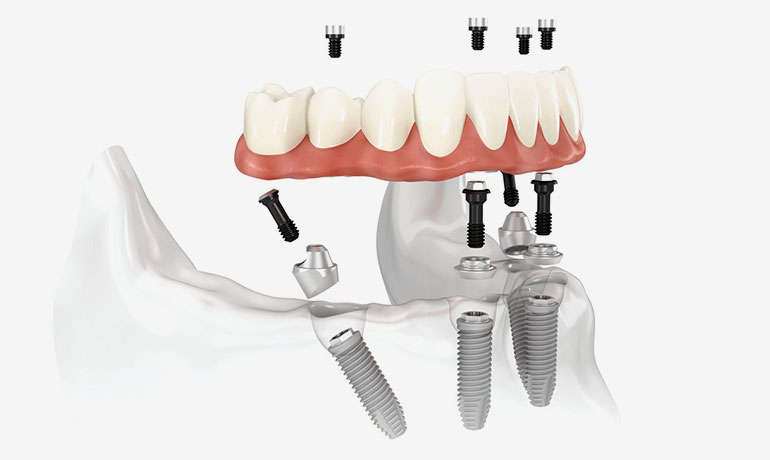 implantologia-a-carico-immediato • DentaClinic Studio Dentistico implantologia-a-carico-immediato
