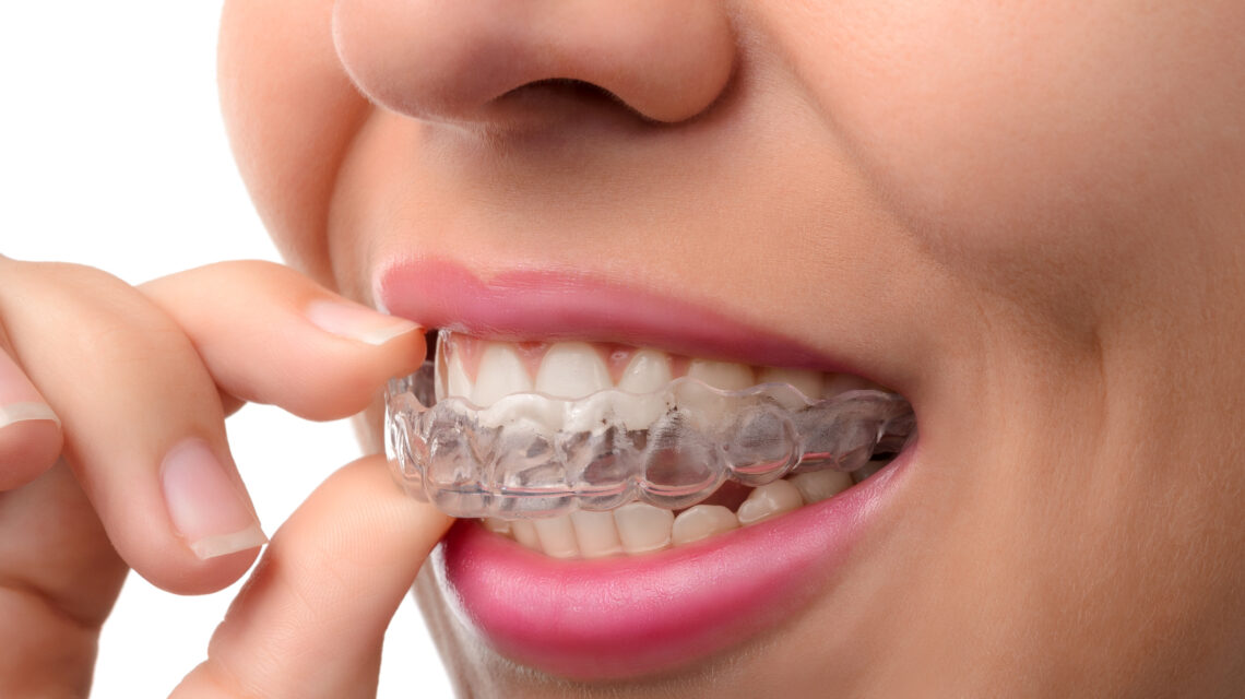 Invisalign apprecchio invisibile