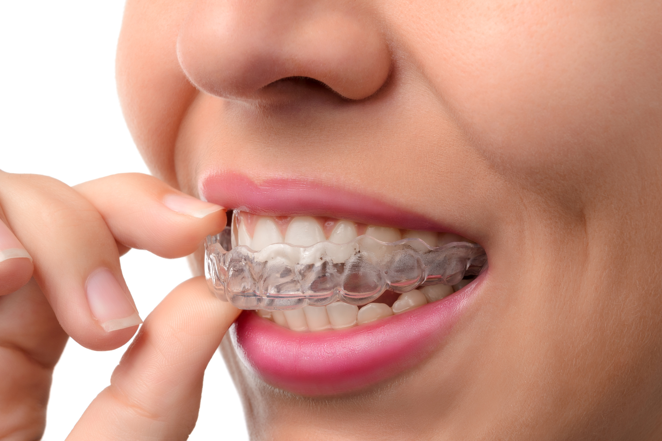 Invisalign apprecchio invisibile • DentaClinic Studio Dentistico Invisalign apprecchio invisibile