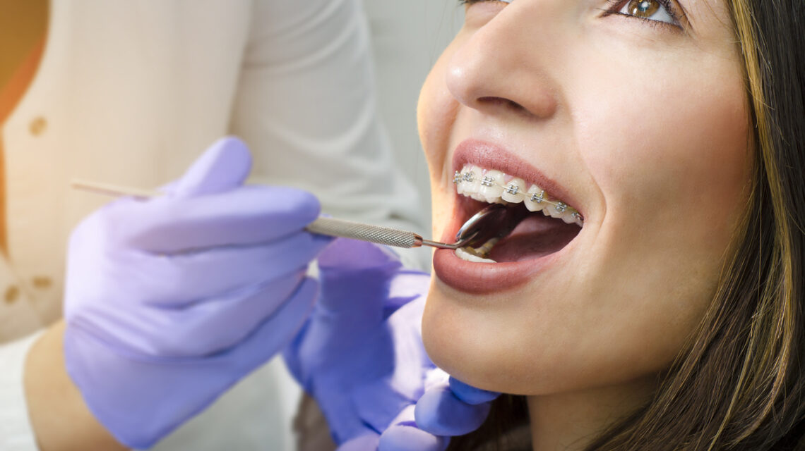 Come lavare i denti con l'apparecchio fisso