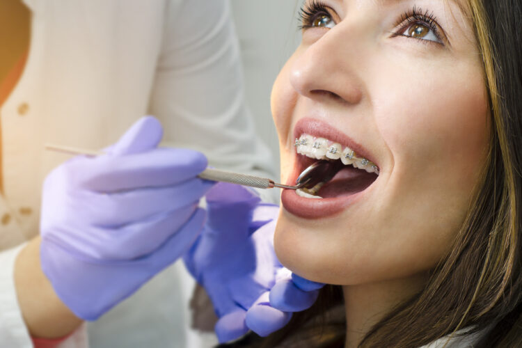 Come lavare i denti con l'apparecchio fisso