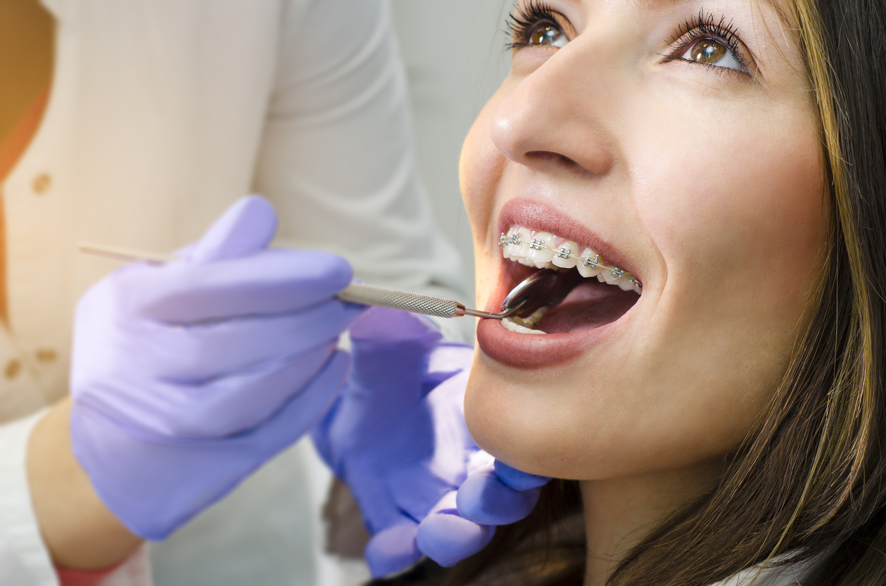 Come lavare i denti con l'apparecchio fisso